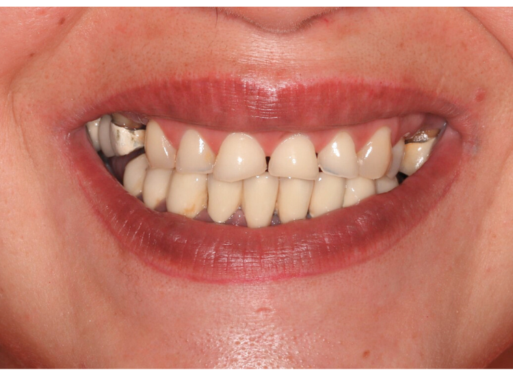 dentadura imperfecta, tratamiento odontológico, antes y después dental