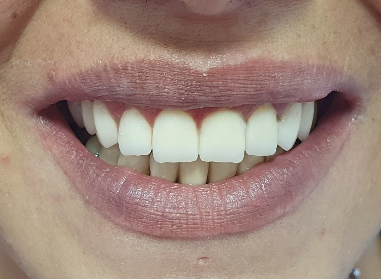 Rehabilitación dental, Reconstrucción dental,